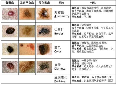 有問題的痣|担心痣变成恶性黑色素瘤？有 5 种痣要注意